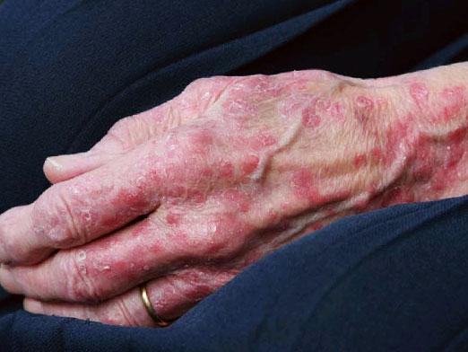 Hoe dermatitis behandelen?