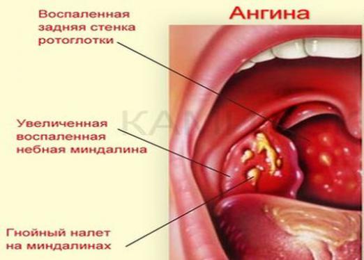 Wat is angina?